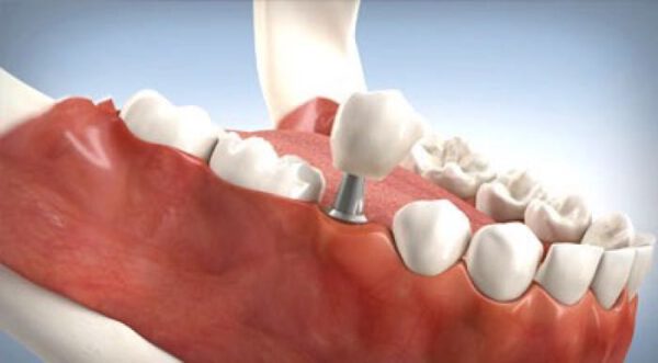 Zahnimplantate – Lebensqualität durch Ihren Zahnarzt in München steigern